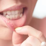Canker Sores Treatments