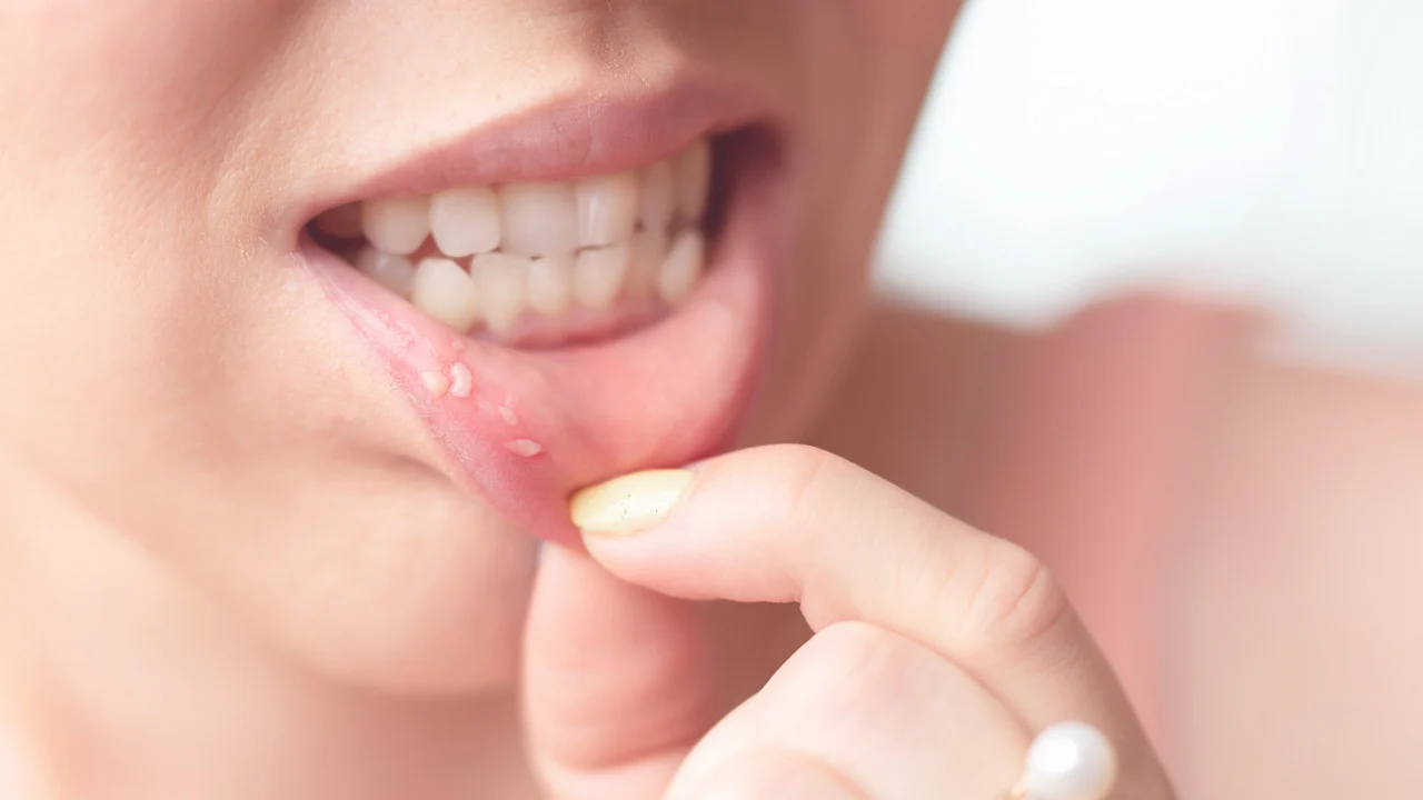 Canker Sores Treatments