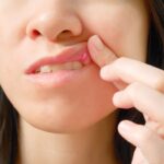 Canker Sores Treatments