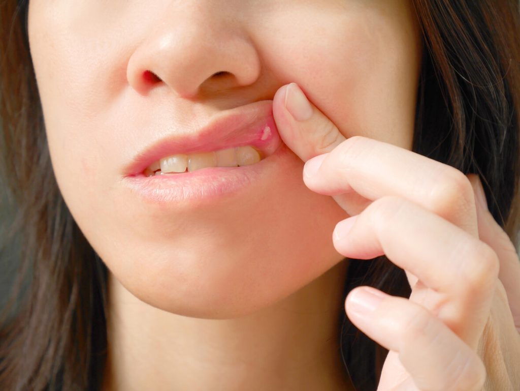 Canker Sores Treatments
