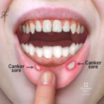Which Canker Sores Treatments Work Without Medication
