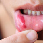 Why Canker Sores Treatments Are Often Misused