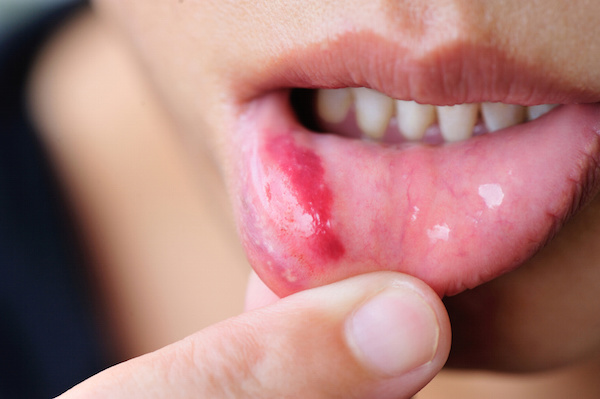 Why Canker Sores Treatments Are Often Misused