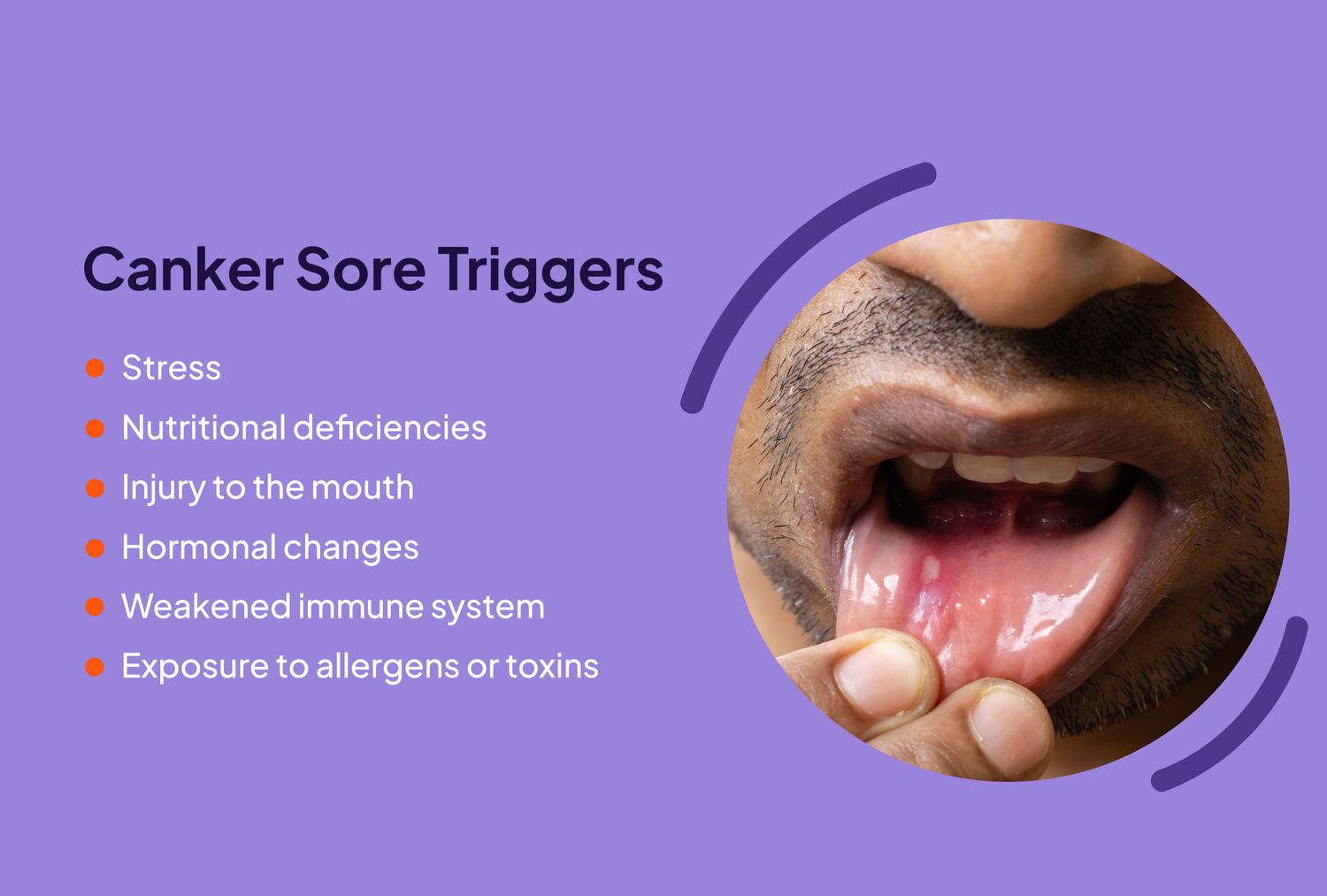 Why Canker Sores Treatments Matter For Teenagers