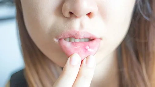 How Canker Sores Treatments Ease Daily Discomfort