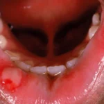 Why Canker Sores Treatments Differ By Severity