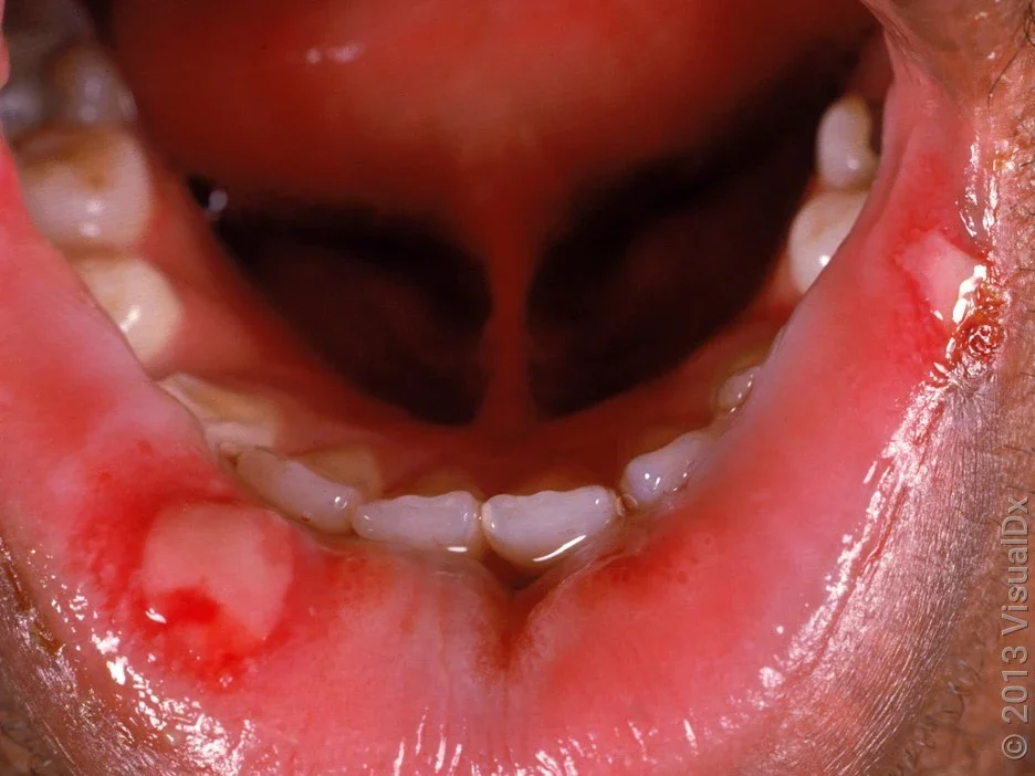 Why Canker Sores Treatments Differ By Severity