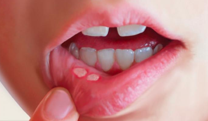Can Canker Sores Treatments Prevent Future Ulcers