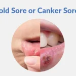 What Canker Sores Treatments Offer For Recurrent Cases