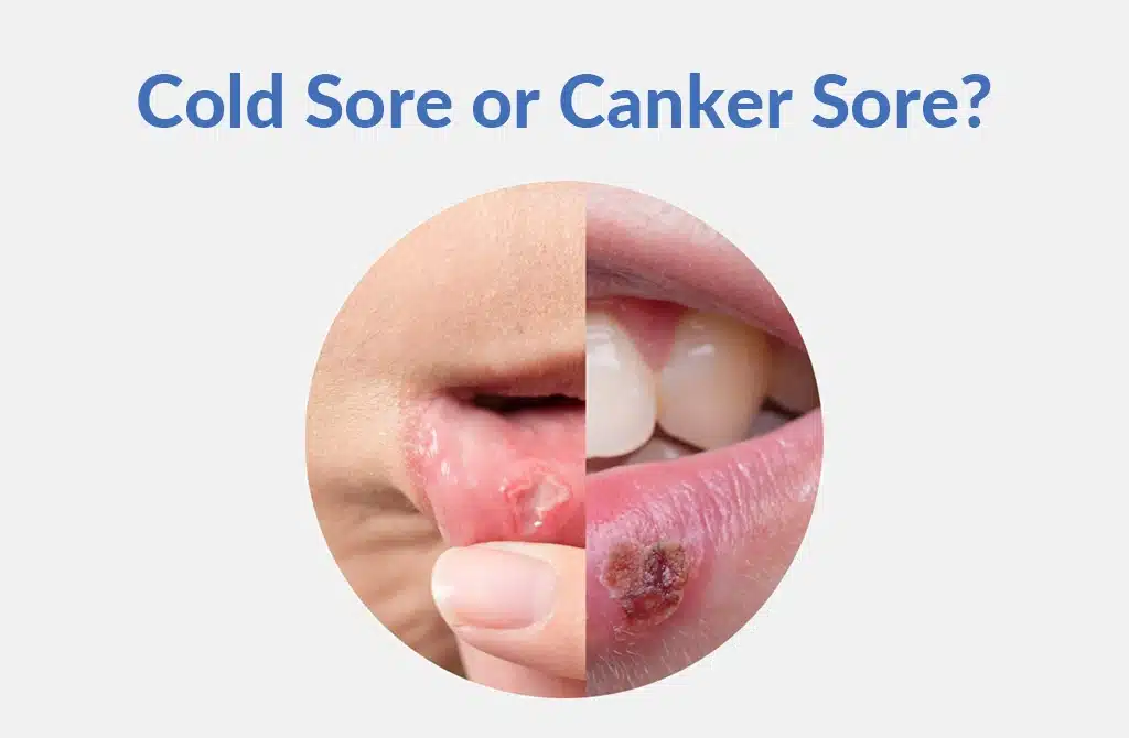 What Canker Sores Treatments Offer For Recurrent Cases