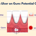 Can Canker Sores Treatments Help Stress-Related Ulcers