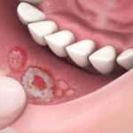 How Canker Sores Treatments Calm Irritated Tissue