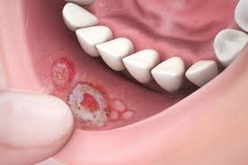 How Canker Sores Treatments Calm Irritated Tissue