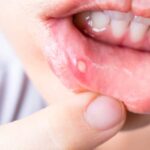 What Make Canker Sores Treatments Work Quickly