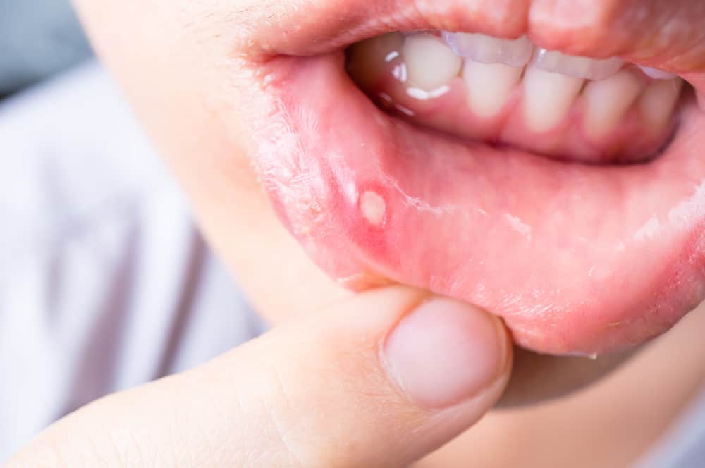 What Make Canker Sores Treatments Work Quickly